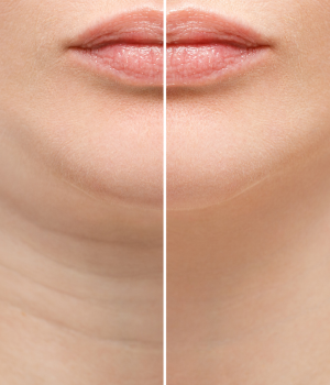 Antes e Depois Papada